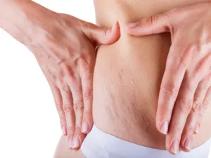 Stretch Marks - Laser Stretch Mark Reduction Image