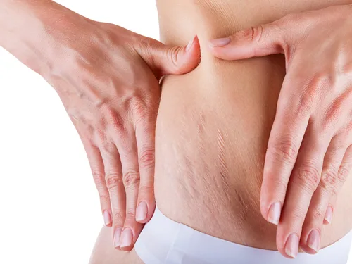 Stretch Marks - Laser Stretch Mark Reduction Image