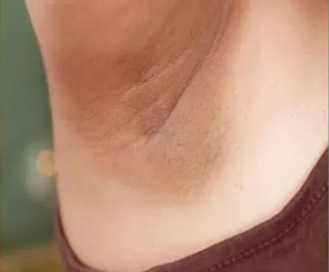 Intimate Lightening Before and After Under Arm