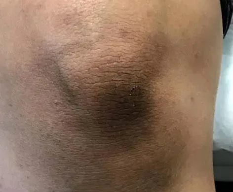 Intimate Lightening Before and After Knee