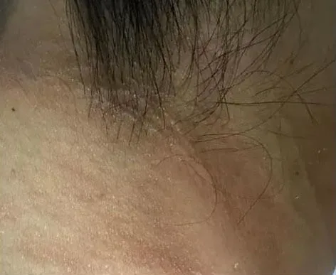 Intimate Lightening Before and After Neck