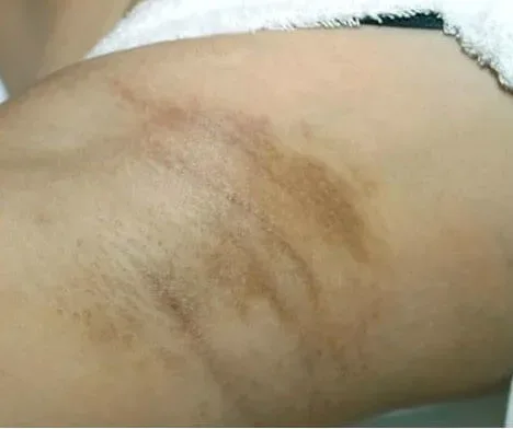 Intimate Lightening Before and After Under Arm