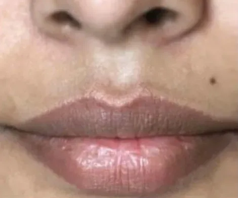 Intimate Lightening Before and After Lips