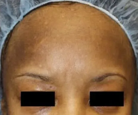 Intimate Lightening Before and After forehead