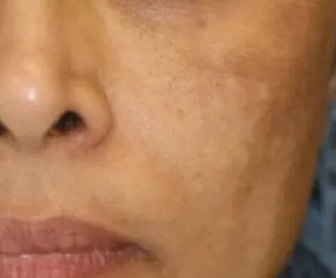 Intimate Lightening Before and After Face
