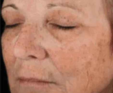 Intimate Lightening Before and After Face