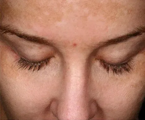 Intimate Lightening Before and After Forehead and Face