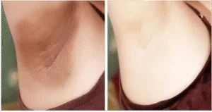 Before and after intimate lightening