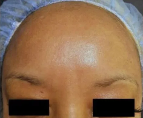 Intimate Lightening Forehead