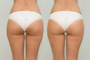 cellulite removal