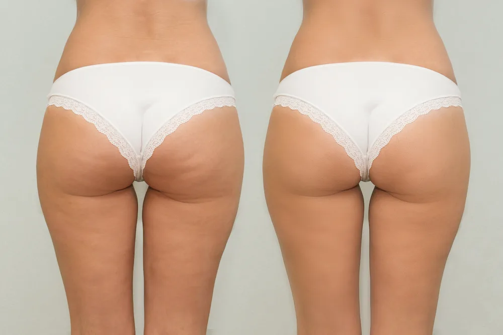 cellulite removal