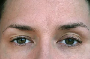 woman with ptosis