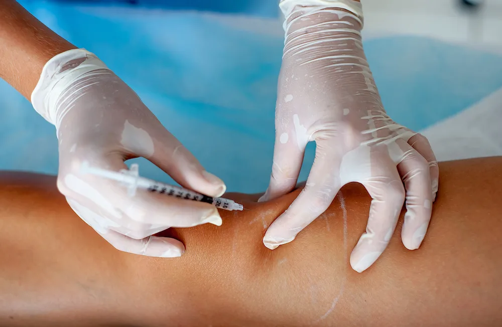 Person getting spider veins removed with sclerotherapy