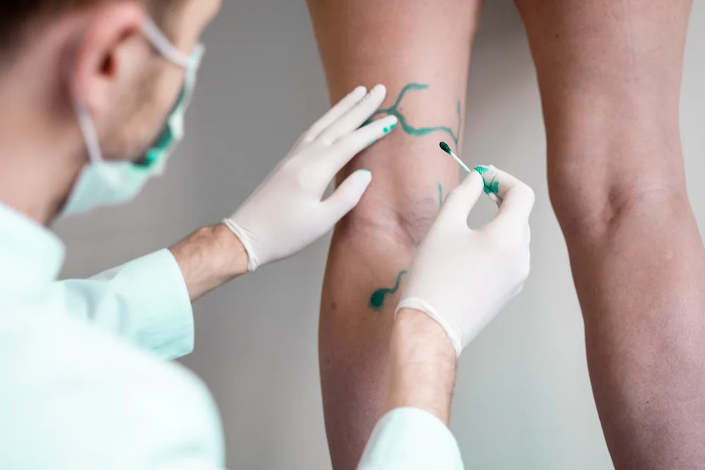 doctor outlining spider veins for sclerotherapy