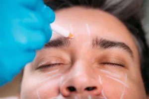 man getting filler and botox in los angeles